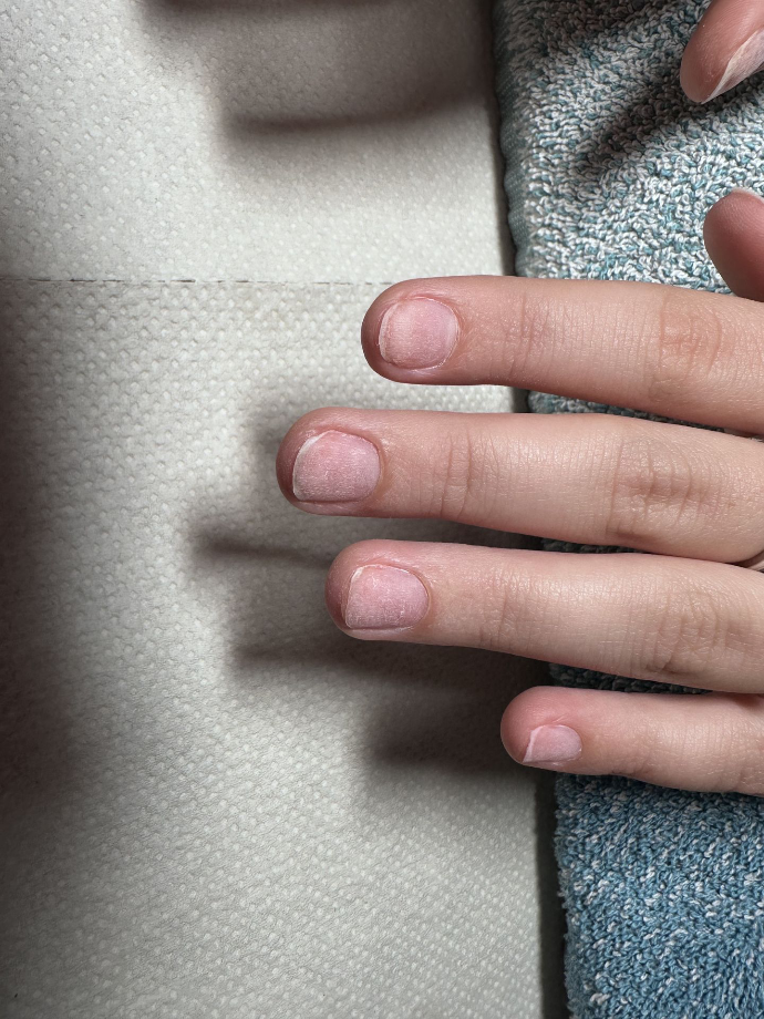 beschadigde nagels BIAB